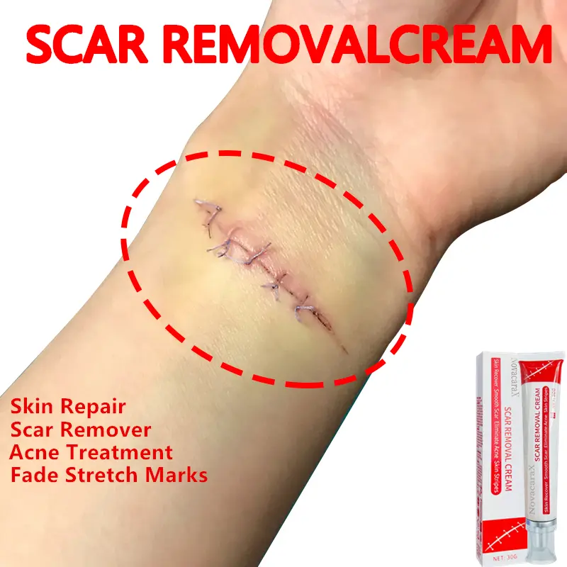 Professional Strong Scar Gel - For scar removal treatment of post-operative scars, keloids, burns, cesarean scars, acne and more.