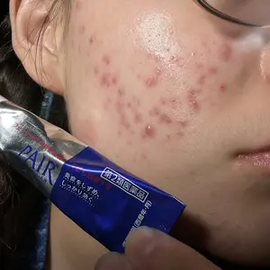 Product Review of Lion Pair Acne Cream Acne Treatment Pimples Removal Cream Pair Acne Creamy Foam Facial Wash Gentle Antibacterial from A**z