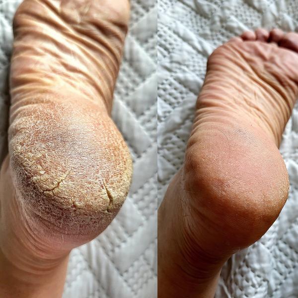 Sap Chap Hand & Foot Cream - All-Natural Whipped Moisturizer for Dry Skin & Cracked Feet - 80g - Chemical-Free, Preservative-Free, Handmade in Small Batches