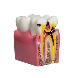 Caries Anatomical Contrast Model for Teaching Demonstration