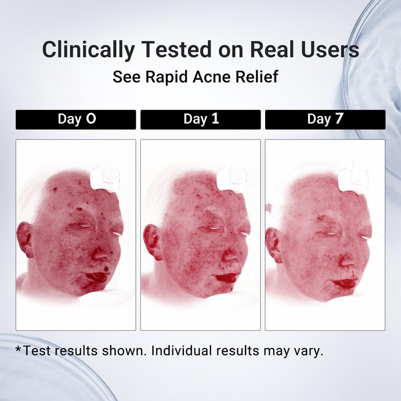 Dr. Leo Drying Lotion Plus 20ml – Upgraded Acne Spot Treatment with 1.8% Encapsulated Salicylic Acid & 4% Niacinamide & 10% Sulfur