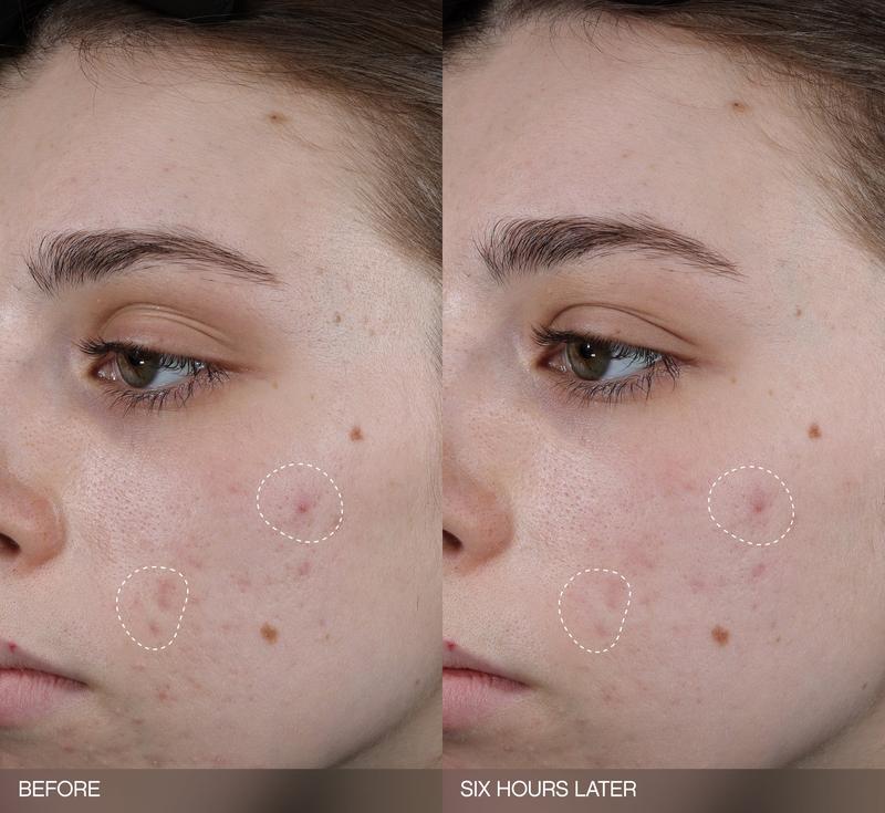 Faded Dark Spot Patches -  Brightening Patches for Hyperpigmentation + Post Breakout Marks