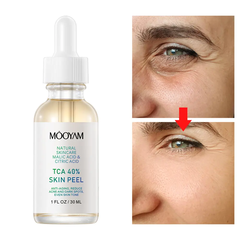 Instant Radiance Peel: TCA 40% Skin Peel for Youthful Glow Skincare Exfoliant Gentle Skin Repair Comfort