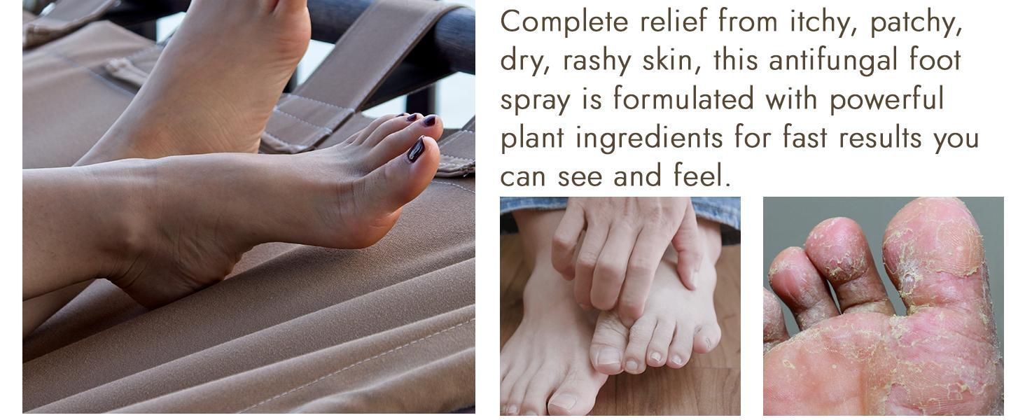 Antifungal Foot Powder with Miconazole Nitrate 2% & Tea Tree Oil | Athletes Foot Treatment for Itchy Skin & Odor Control | Prevents Reinfection | Fast-Drying Powder | Pack of 3 Antifungal Foot Powder with Miconazole Nitrate 2% & Tea Tree Oil | Athletes Foot Treatment for Itchy Skin & Odor Control | Prevents Reinfection | Fast-Drying Powder | Pack of 3