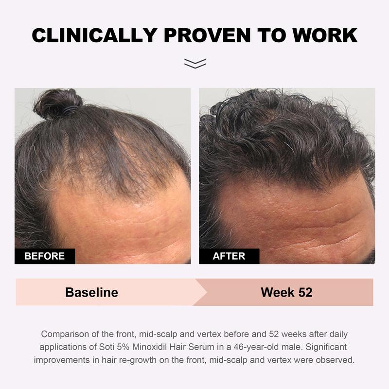 5% Minoxidil Hair Growth (3 months supply), Hair Loss Regrowth Serum 180ml.  Dermatologists Recommended. Ginseng and Biotin Extra Strength Formula