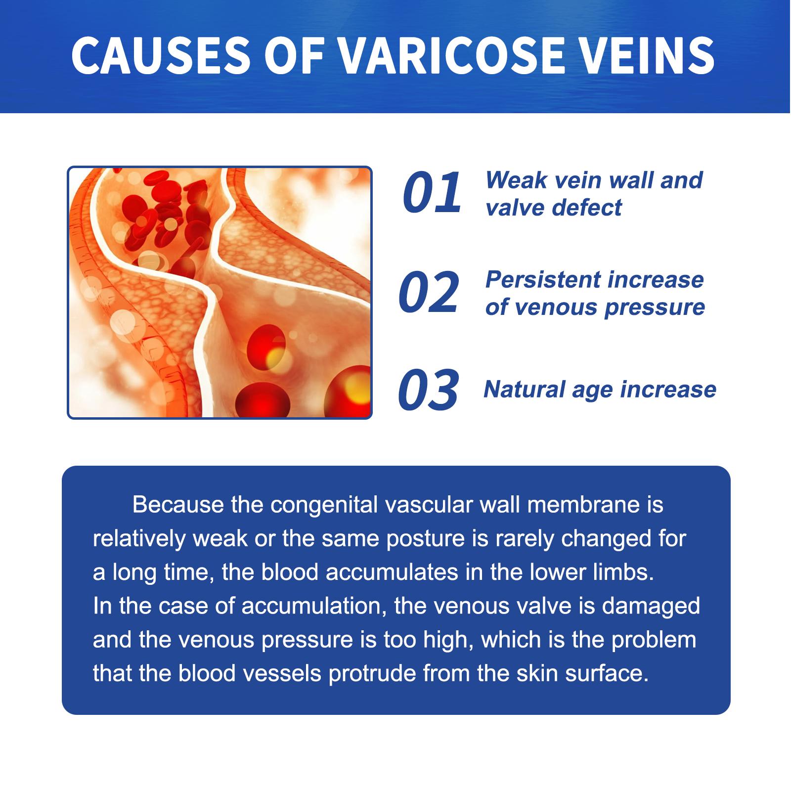 Vein Massage Varicose Cream Repair Earthworm Legs To Relieve Leg Blood Vessel Bulge And Varicoidea