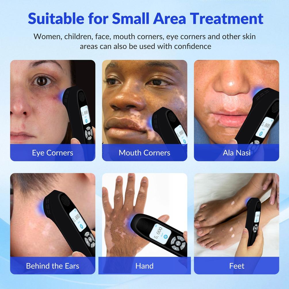 ZJZK 9 Diodes 308nm UVB Excimer Phototherapy Device, 65mW/cm² High Energy Density, Handheld Blue Light Skin Treatment, Targeted Therapy for Vitiligo, Psoriasis, Eczema, Atopic Dermatitis, Portable Home Use for Skin Disorders