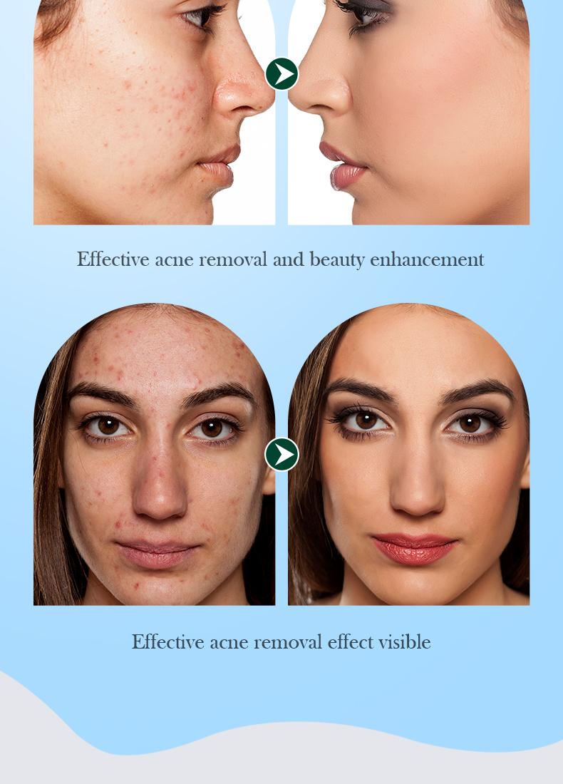 Tea tree acne oil control essence, lightens acne marks, natural cleansing and acne removal, removes blackheads, repairs skin essence