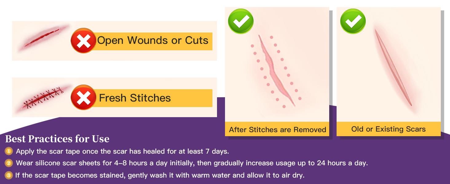 Silicone Scar Sheets,Silicone Scar Tape,Silicone Scar Removal Strips for Surgical,C-Section,Tummy Tuck,Keloid Scars (1.6"X 59" Roll-1.5M) Keloid Bump Removal