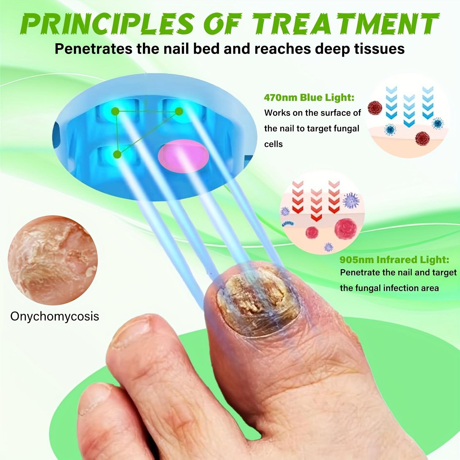 FDA-Cleared Jitesy Nail Laser Device | 7-Minute Home Nail Care for Fingernails & Toenails