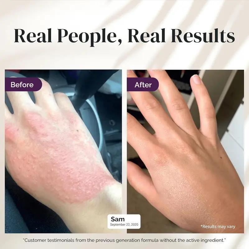 5-in-1 Eczema Cream for Babies, Kids & Adults | Colloidal Oatmeal Lotion for Dry, Itchy Skin | Intensive Face & Body Moisturizer | Clinically Tested for Sensitive, Irritated Skin