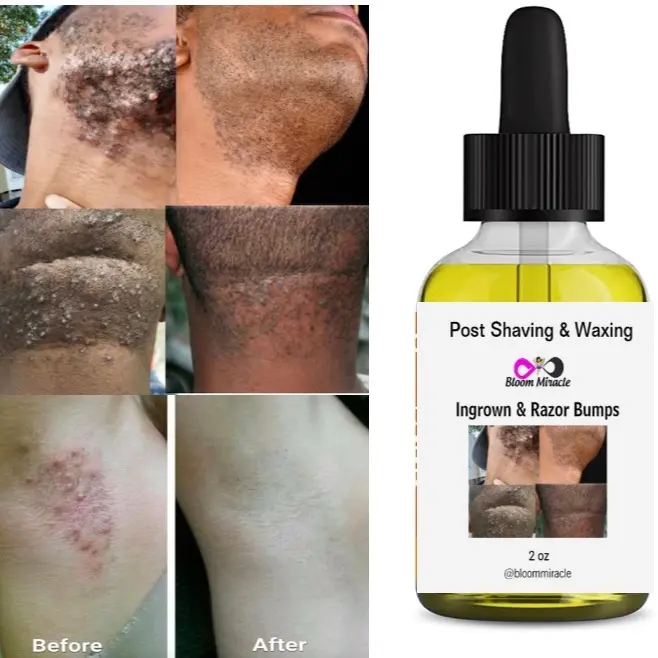 Ingrown Hair Removal Razor Bump Tea Tree Jojoba Lavender Cosmetic Comfort