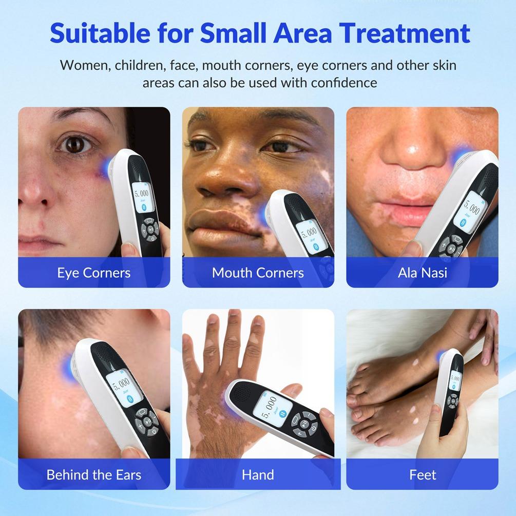 ZJZK 9 Diodes 308nm UVB Excimer Phototherapy Device, 55mW/cm² High Energy Density, Handheld Blue Light Skin Treatment, Targeted Therapy for Vitiligo, Psoriasis, Eczema, Atopic Dermatitis, Portable Home Use for Skin Disorders