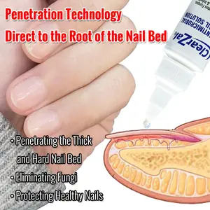 ClearZal Antimicrobial BAC Nail Solution Fungal Nail Treatment 1 Ounce Kills Fungus, Bacteria and Viruses Nail Care [YW]