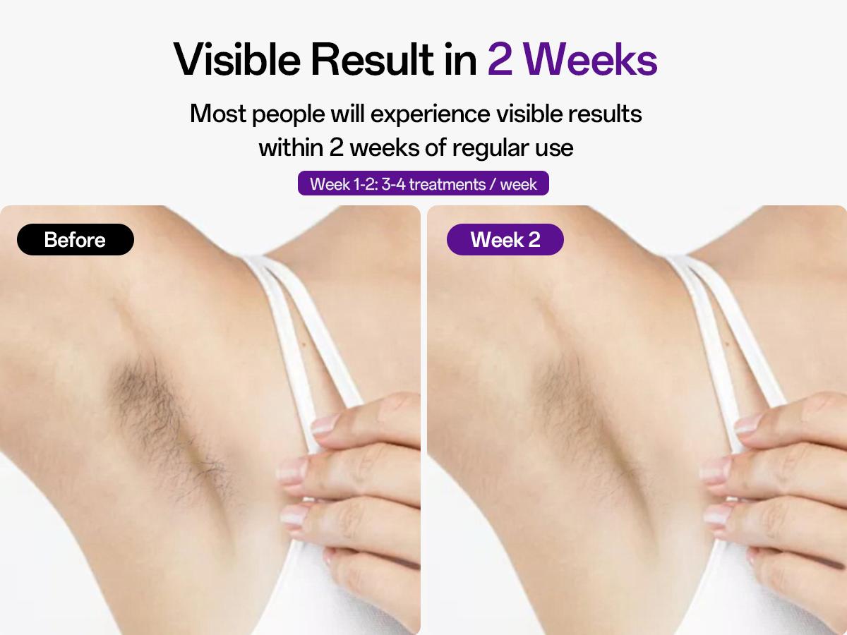 Laser Hair Removal Device for Women & Men, At-Home Painless IPL Laser Hair Remover with 40°F Ice-Cooling Contact, Long-Lasting Lazer Hair Removal for Face, Legs, Armpits, Bikini Line