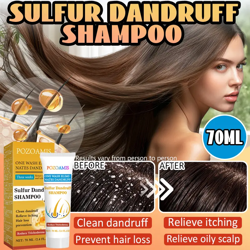 POZOAMIS Sulfur Dandruff Shampoo, Fast Itchy Scalp Relief & Hair Loss Prevention, Reduce Trichoderma & Clean Dandruff, Deep Scalp Cleansing Care Routine Hack for Fresh Itchless Scalp Scent