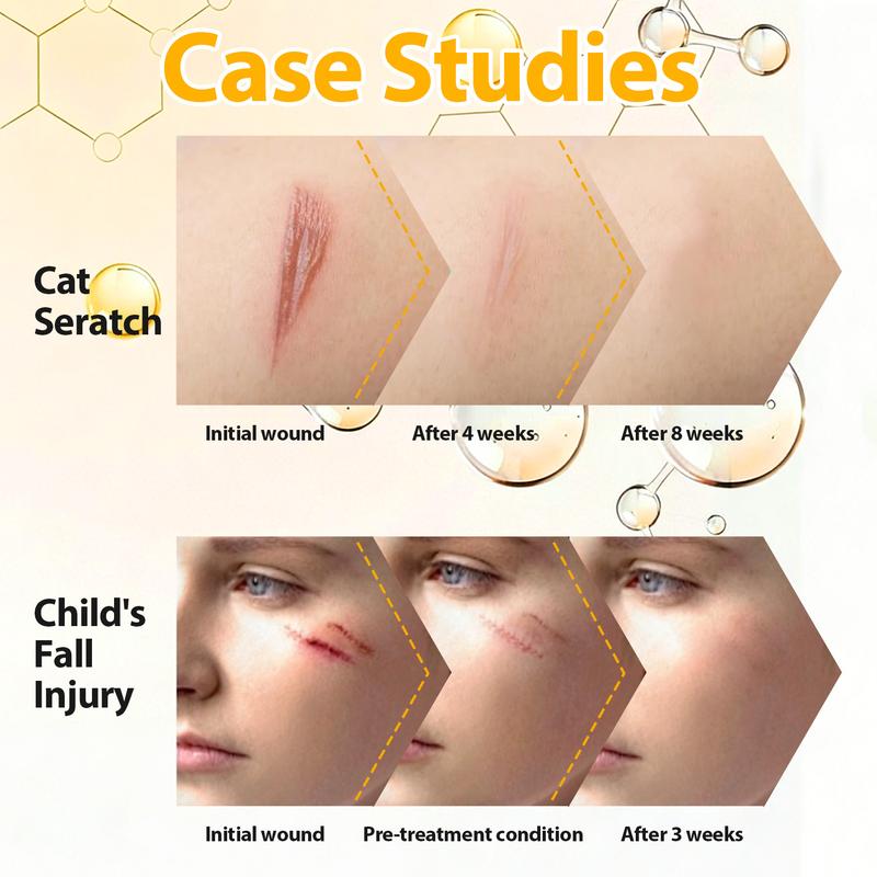 【HERBAP MATRIX Plus】 Scar Removal Gel 15g - Professional Silicone Scar Treatment for Stretch Marks, C‑Section, Acne Scars & Acne Marks | Helps Prevent Scar Thickening | Face & Body | GMPC ISO 9001 【HERBAP MATRIX Plus】 Scar Removal Gel 15g - Professional Silicone Scar Treatment for Stretch Marks, C‑Section, Acne Scars & Acne Marks | Helps Prevent Scar Thickening | Face & Body | GMPC ISO 9001
