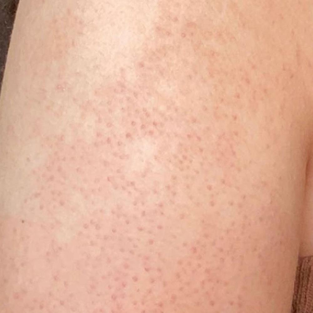 KP Bump Eraser Body Scrub 10% AHA Fresh Strawberry