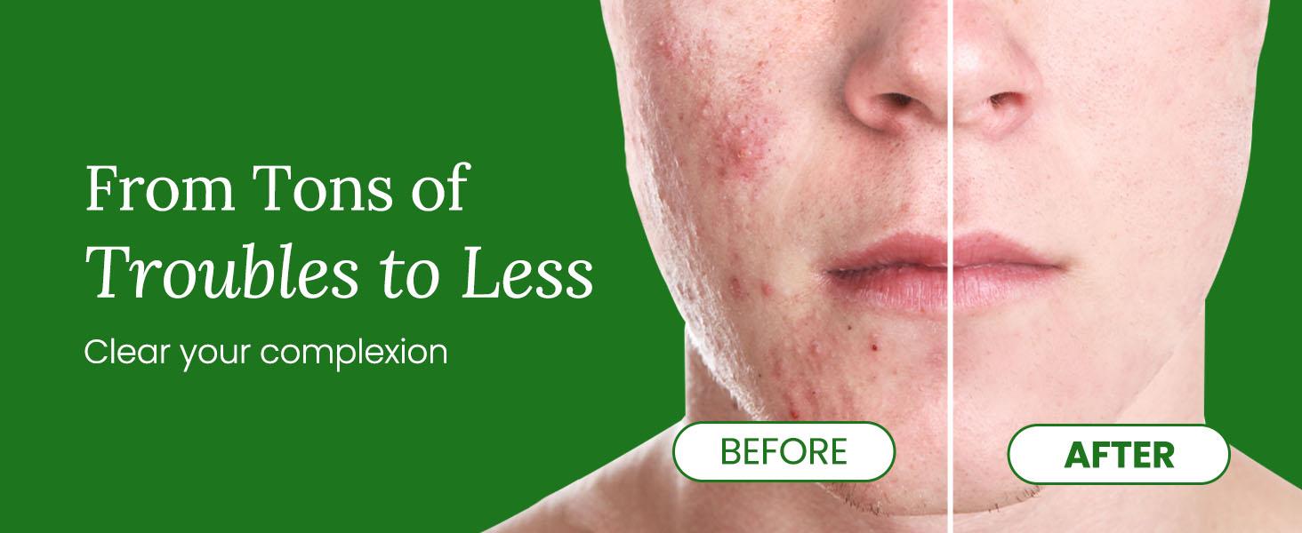 Troubless Invisible Pimple Spot Patch - 96 Ultra Thin Acne Patches - Easy Peel - 2 Sizes Skincare Skin Repair Troubless Invisible Pimple Spot Patch - 96 Ultra Thin Acne Patches - Easy Peel - 2 Sizes Skincare Skin Repair