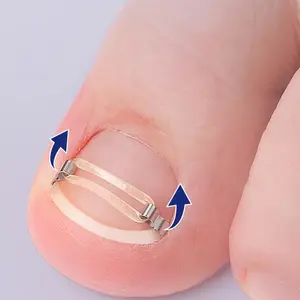 2pcs/Set Ingrown Toenail Tools Set Ingrown ToenailCorrection Patch Stickers Corrector Pedicure Tool ingrownToe Nail Foot Care Tools Manicure Nailkit