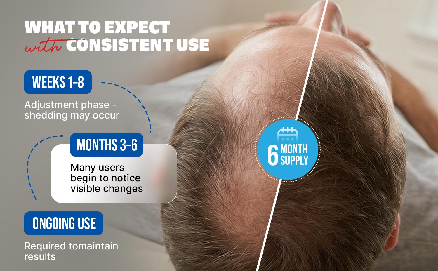 Kirkland Signature Minoxidil 5% Hair Regrowth Treatment for Men, Extra Strength Liquid Topical Solution for Hair Loss & Thinning Hair, Clinically Proven Hair Growth Treatment Kirkland Signature Minoxidil 5% Hair Regrowth Treatment for Men, Extra Strength Liquid Topical Solution for Hair Loss & Thinning Hair, Clinically Proven Hair Growth Treatment