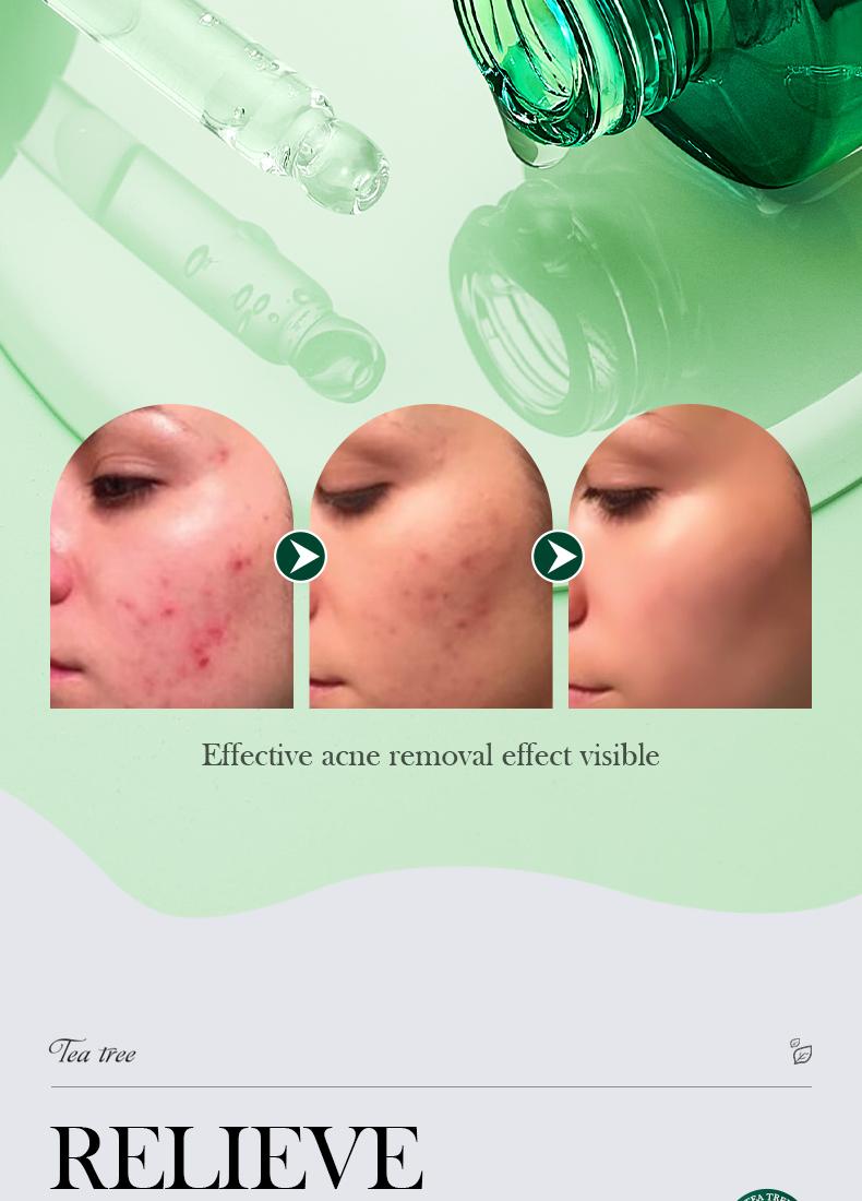 Tea tree acne oil control essence, lightens acne marks, natural cleansing and acne removal, removes blackheads, repairs skin essence