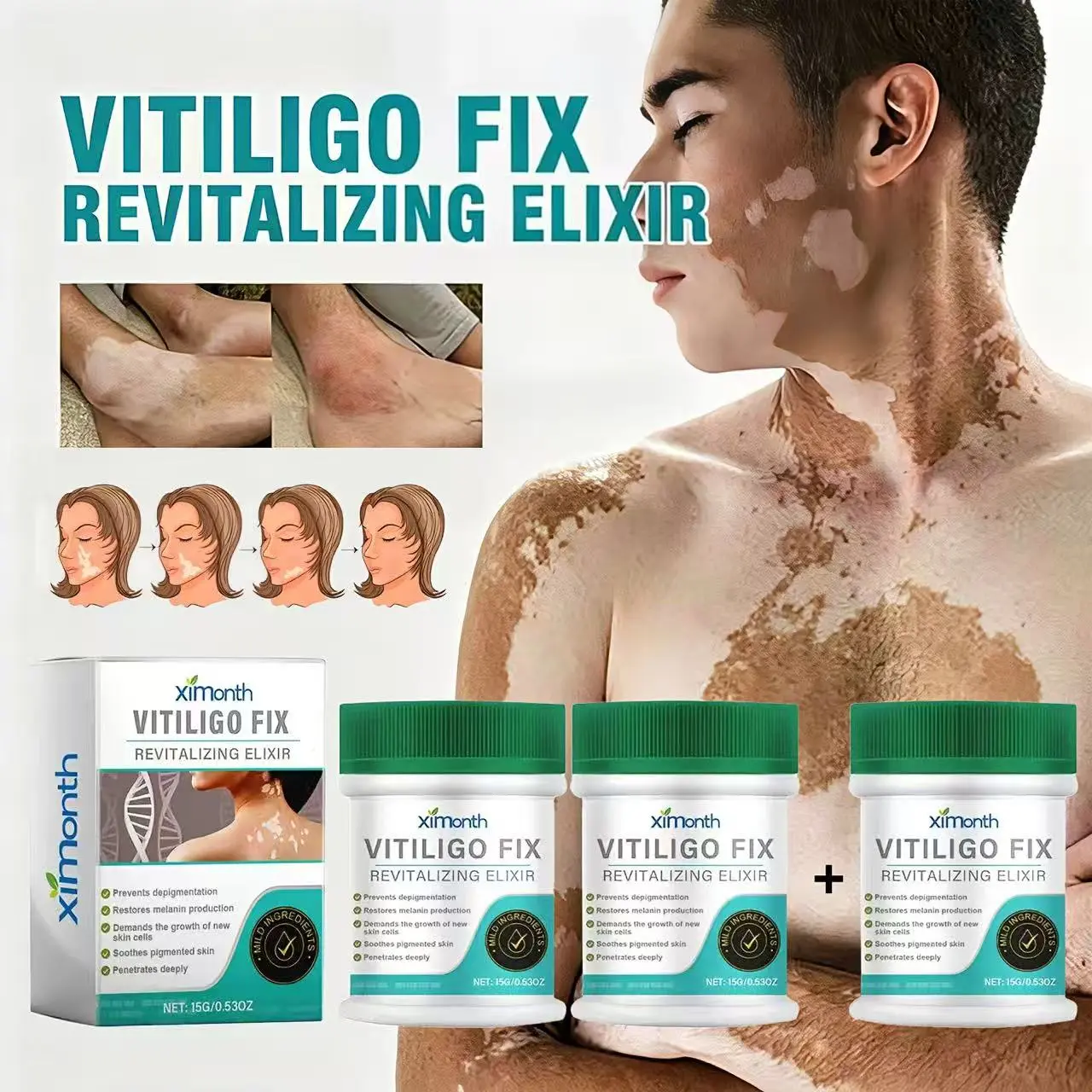 BUY 2 GET 1 Vitiligo Care Cream to Help Restore Pigmentation and Reduce White Spots-Natural Plant-Based Body Care Moisturizer for All Skin Types Vitiligo Fix Revitalizing Elixir;Vitiligo Cream;White Spot Treatment