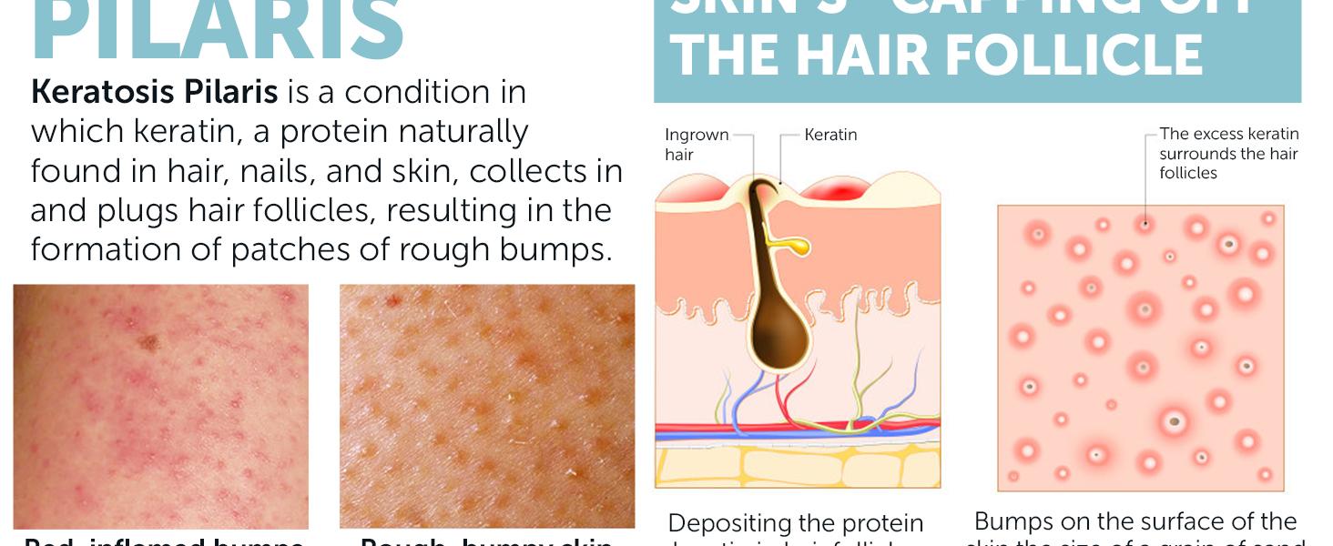 Keratosis Pilaris Treatment | Keratosis Pilaris Lotion with 10% AHA | Gentle Exfoliation For Strawberry Legs, KP & Ingrown Hairs | Smooth & Hydrating Body Lotion For Redness, Dry, Rough And Flaky Skin