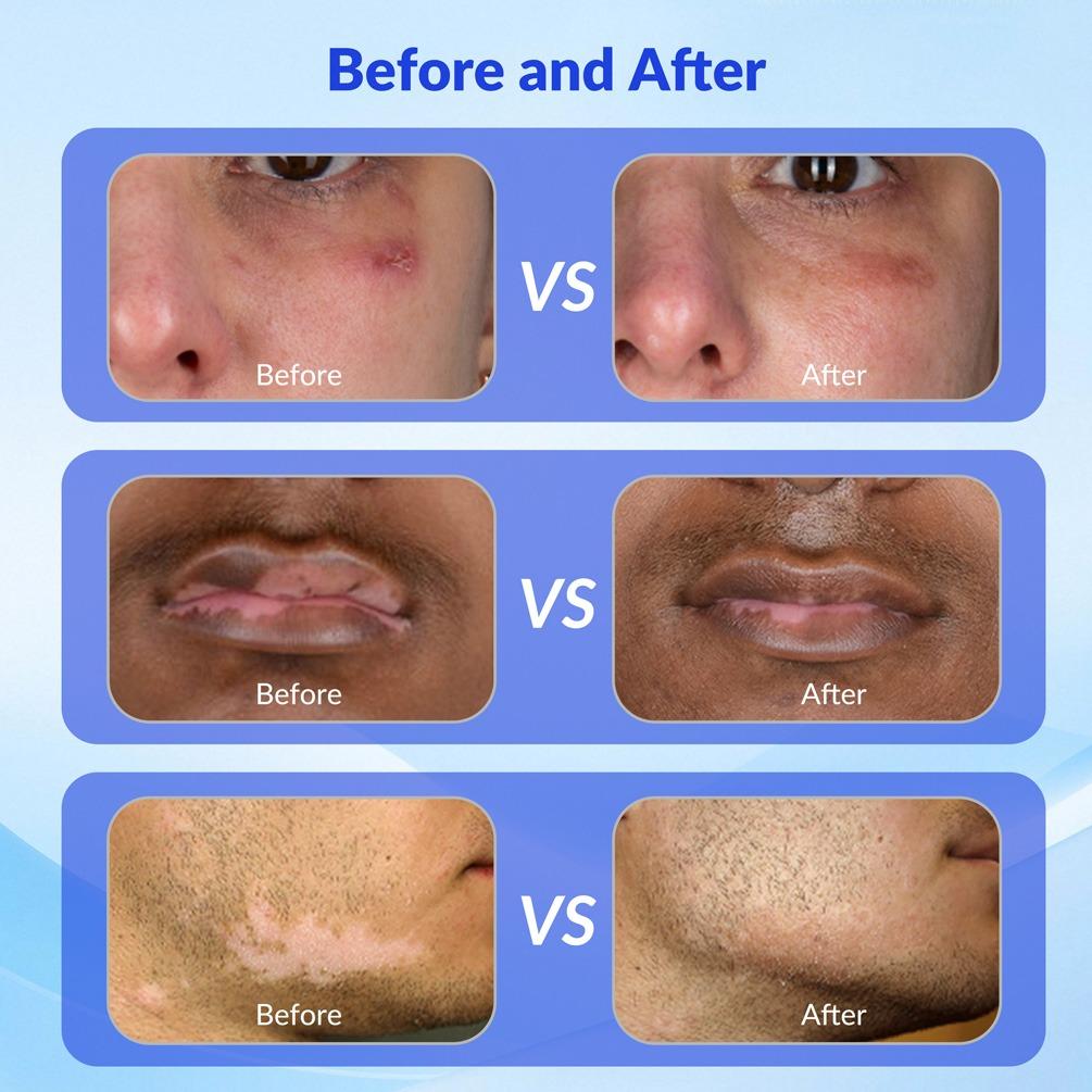 ZJZK 9 Diodes 308nm UVB Excimer Phototherapy Device, 55mW/cm² High Energy Density, Handheld Blue Light Skin Treatment, Targeted Therapy for Vitiligo, Psoriasis, Eczema, Atopic Dermatitis, Portable Home Use for Skin Disorders ZJZK 9 Diodes 308nm UVB Excimer Phototherapy Device, 55mW/cm² High Energy Density, Handheld Blue Light Skin Treatment, Targeted Therapy for Vitiligo, Psoriasis, Eczema, Atopic Dermatitis, Portable Home Use for Skin Disorders