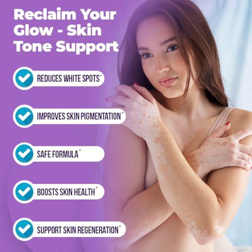 Vitiligo Cream for White Spots (4oz) - Repigmenting Cream with Polypodium Leucotomos and Melanocyte Support - Evens Skin Tone and Reduces Discoloration by Aura Dermacare