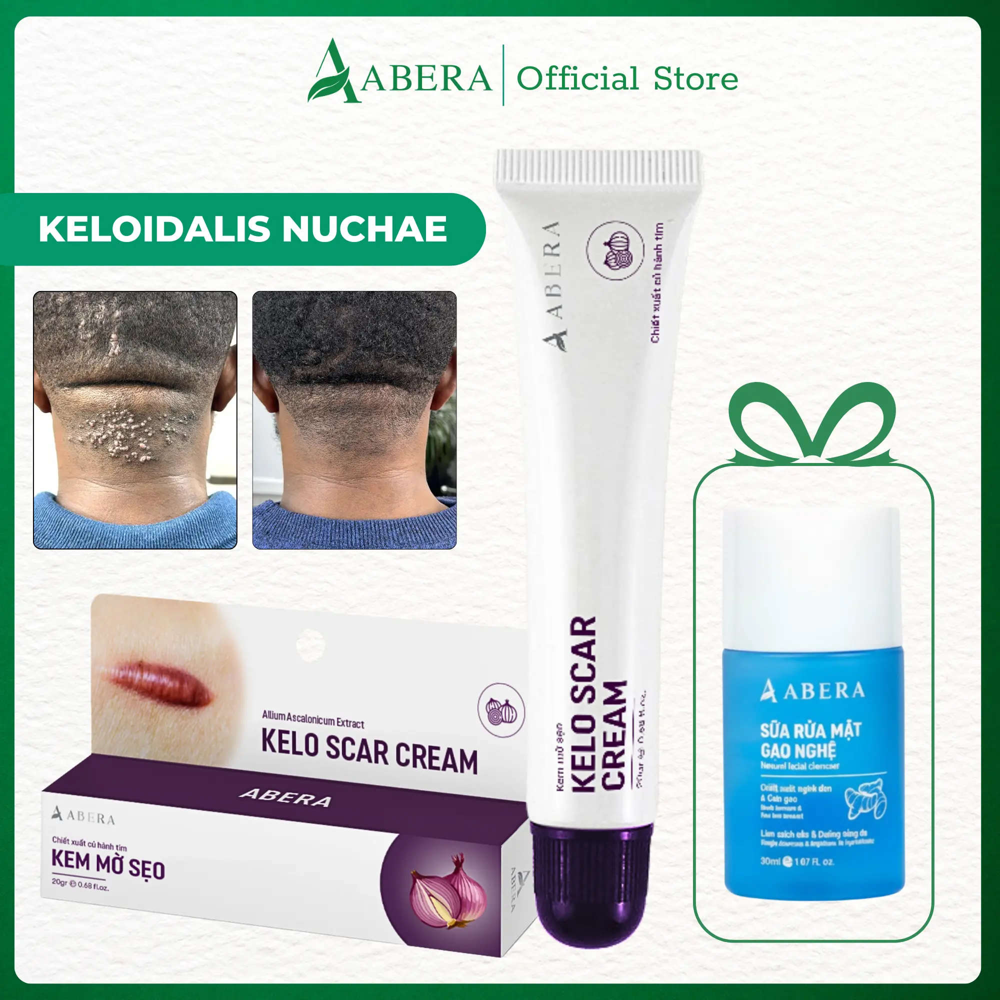 Abera Kelo Scar Cream - Fades Keloids, Hypertrophic Scars, Surgical Scars, Onion Extract - 20g