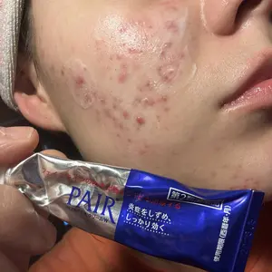 Product Review of Lion Pair Acne Cream Acne Treatment Pimples Removal Cream Pair Acne Creamy Foam Facial Wash Gentle Antibacterial from A**z