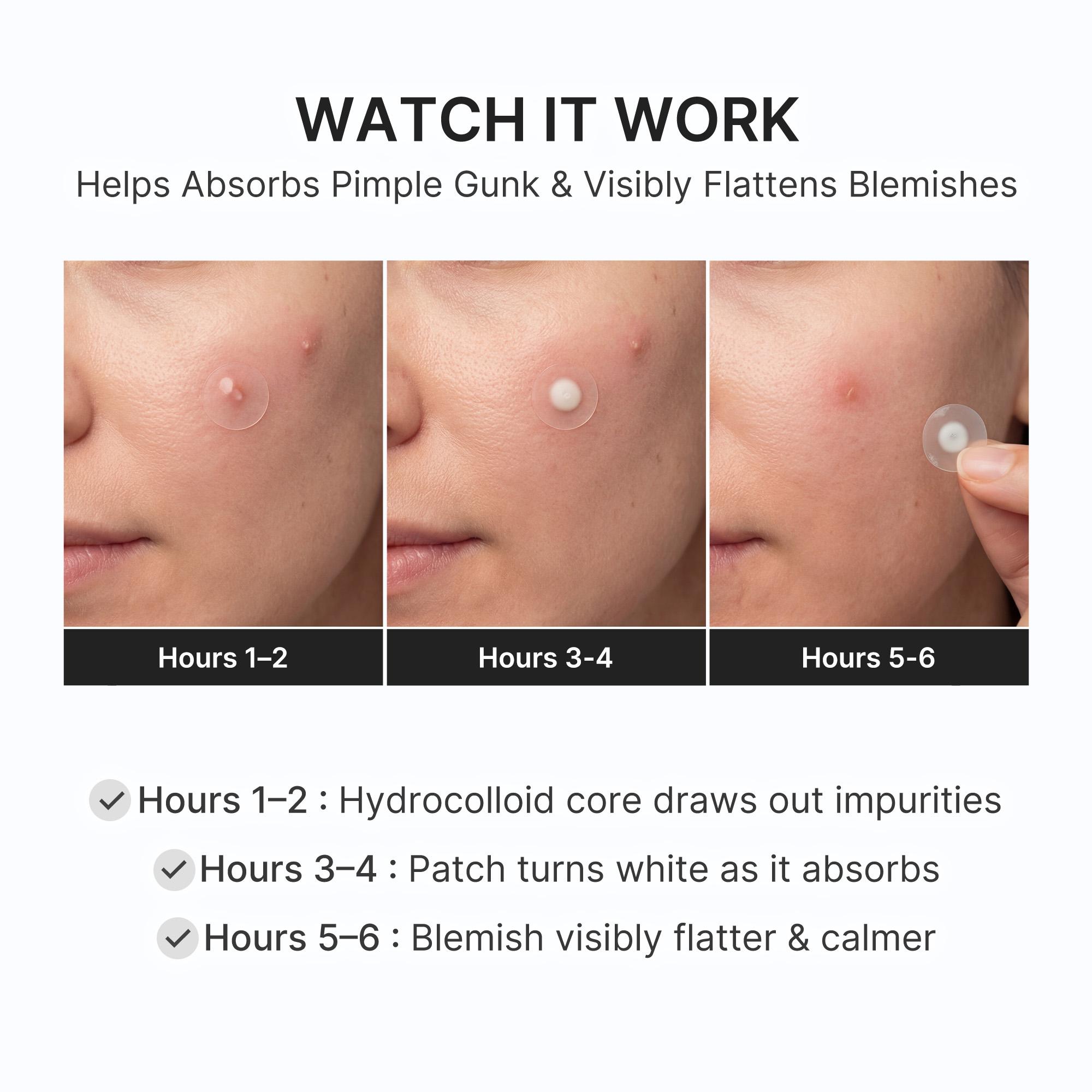 [NEW] [medicube] S.O.S Invisible Patch | Ultra-Thin Hydrocolloid Patch | Spot Care with Salicylic Acid, Tea Tree Oil | Invisible Cover, Absorbs Gunk, Non-Comedogenic Tested | Korean Skincare, 36 Count