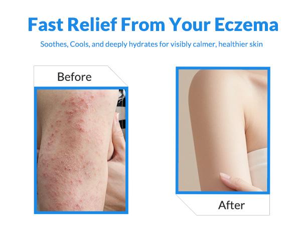 Eczema Relief Cream - Organic Hand & Body Eczema Relief - Natural Honey Lotion for Dry, Itchy, & Irritable Skin