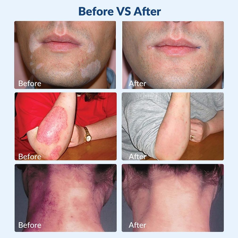 ZJZK 308nm Excimer Phototherapy Device with 49 Diodes, Blue Light Therapy for Vitiligo, Psoriasis, Eczema, Atopic Dermatitis, Fungal Skin Disease, Hypopigmentation, Safe Targeted Home Use, Fast Recovery, Prevent Recurrence, Portable Handheld