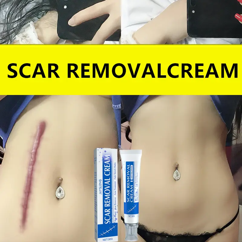 Professional Scar Removal Gel- Scarremoval treatment for keloids, C-sectionS, surgeries, burns, acne andmore.