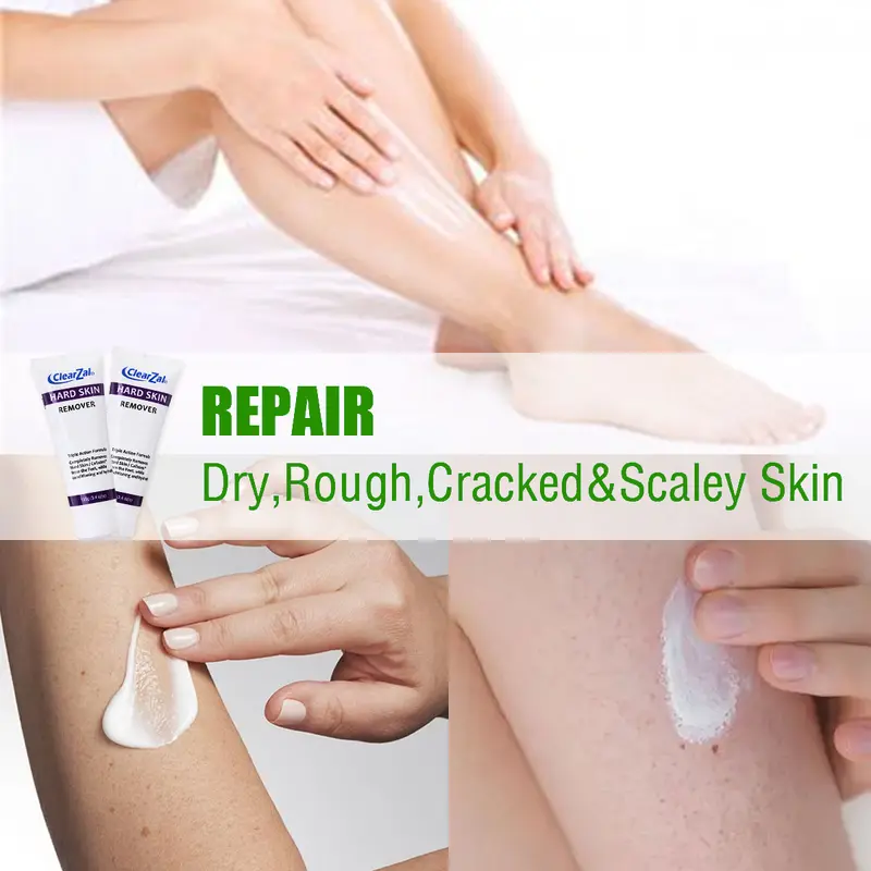 ClearZal targets chicken skin on arms and legs and enlarged pores,  improves it, and can be used all over the body Triple action formula exfoliates old skin cells 3.4 Ounce [YW]