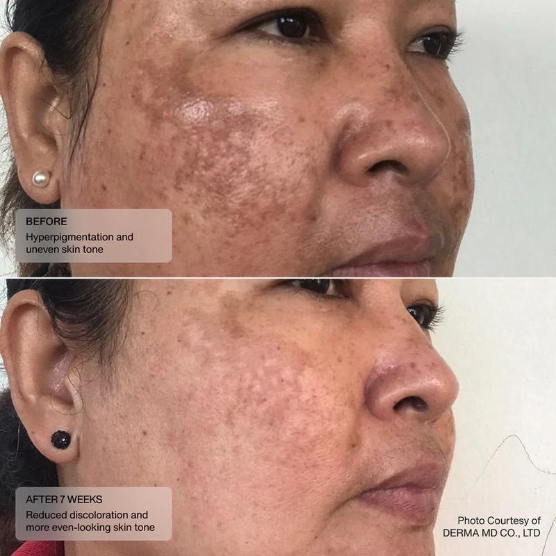 Senté Even Tone Retinol Cream 1.0 oz with Pure Retinol and HSA - Efficiently Improves Skin Tone, Texture, and Dark Spots - Hydrating