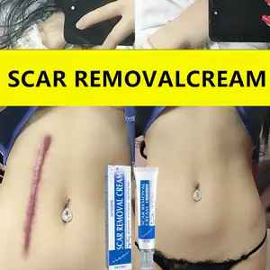 [Authentic] Scar Removal Gel - Scar removal treatment for keloids, caesarean section scars, surgical scars, burn scars, acne, etc.-3