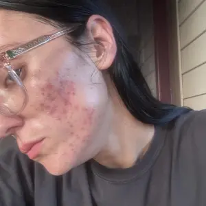 Product Review of Lion Pair Acne Cream Acne Treatment Pimples Removal Cream Pair Acne Creamy Foam Facial Wash Gentle Antibacterial from K**a B**h