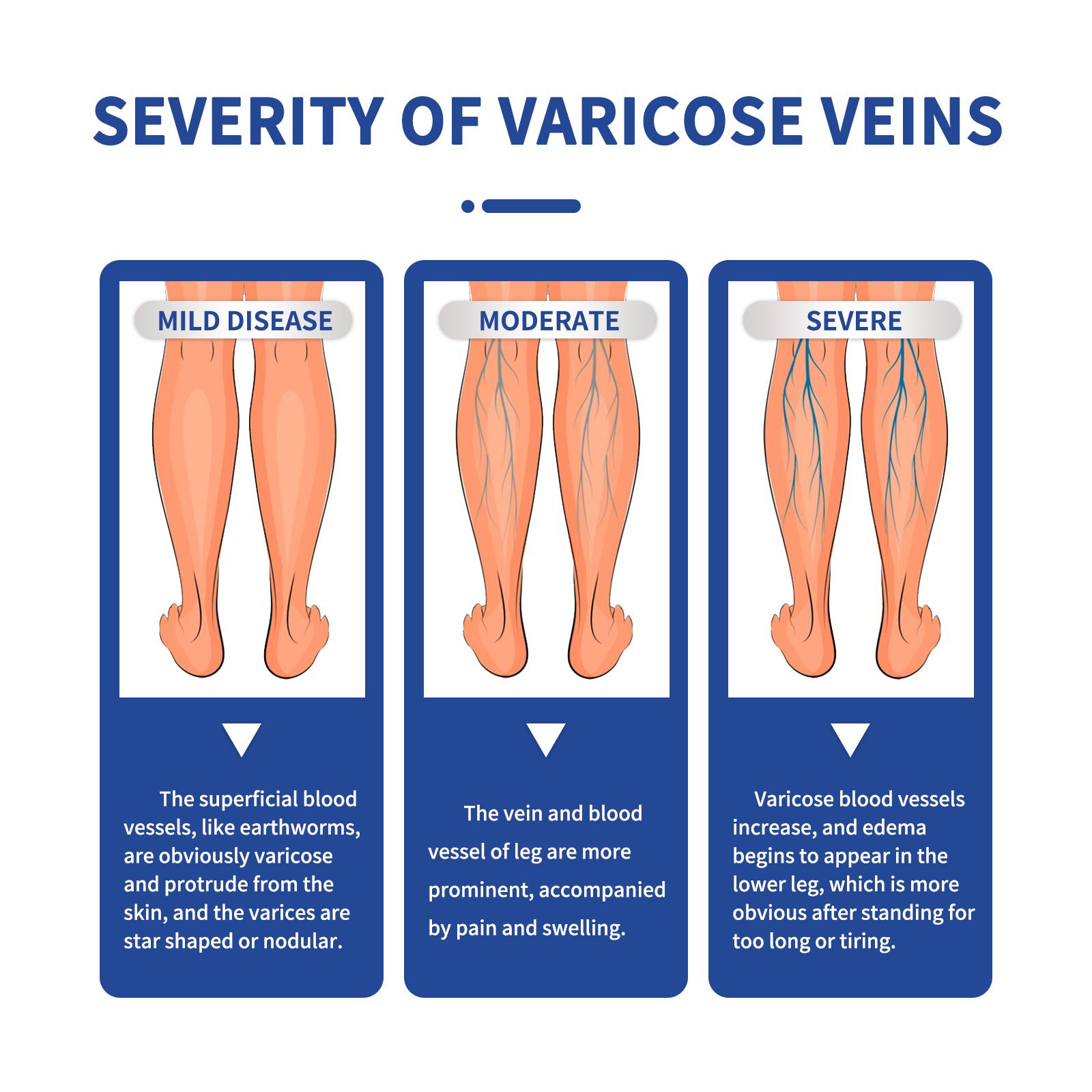Vein Massage Varicose Cream Repair Earthworm Legs To Relieve Leg Blood Vessel Bulge And Varicoidea