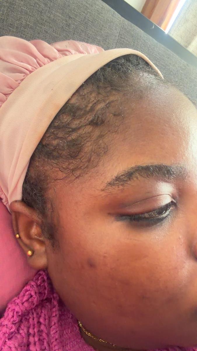 Item: 1box+microneedle roller