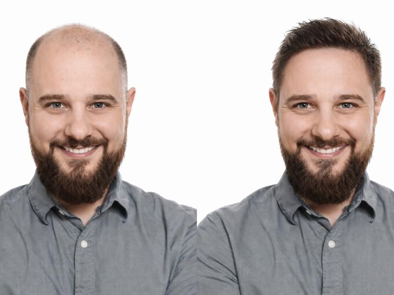 XIFYHO Reedle Shot Hair Ampoule30ml | Hair Growth Hair loss treatment ampouleserum