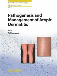 USED-Pathogenesis and Management of Atopic Dermatitis (Current Problems in Dermatology) by Shiohara Tetsuo Ed (Hardcover)