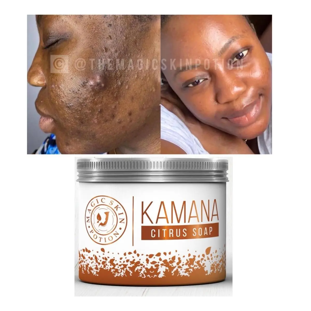 KAMANA Citrus Facial Soap, Acne Remedy for Dark Spots with Rose Water, pH Balancing Cleanser for Sensitive Skin, Scent, Skin Repair, Eczema Relief, Anti-Acne, Age Spot Solutions, Natural Oil Skin Care Solution Gentle Ph Balanced