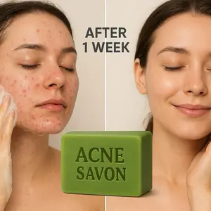 ( 3 )Acne Soap - Natural Handmade Soap with Ivory Base, Cerasee & Lemon for Clear Glowing Skin, Reduces Dark Spots & Fades Acne Scars