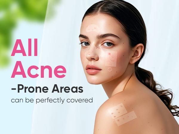 Microdart Acne Patch for Post Acne Stage - 9 Microneedle Pimple Patch and 30 Sealed Acne Patch and 96 Hydrocollooid for Dark Spots, Post-Blemish Redness and Hyperpigmentation (Pink Star) Calendula Hyaluronic