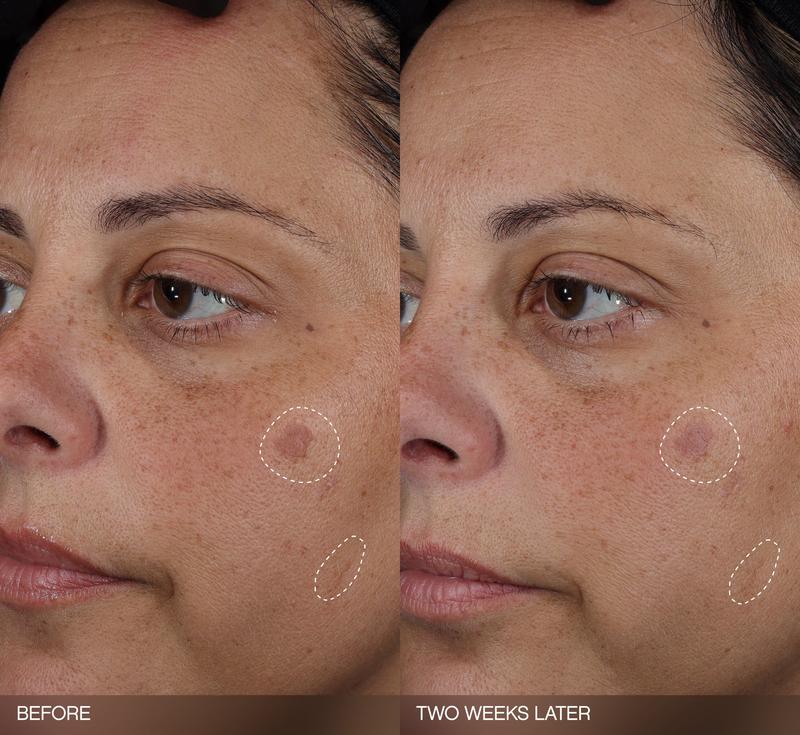 Faded Dark Spot Patches -  Brightening Patches for Hyperpigmentation + Post Breakout Marks