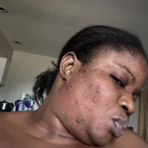 Dr.Leo Drying Lotion Plus | Visibly Shrinks Pimples in 24 Hours & Helps Fade Acne Marks in 7 Days | With 1.8% Encapsulated Salicylic Acid, 4% Niacinamide & 10% Sulfur  (20ml)