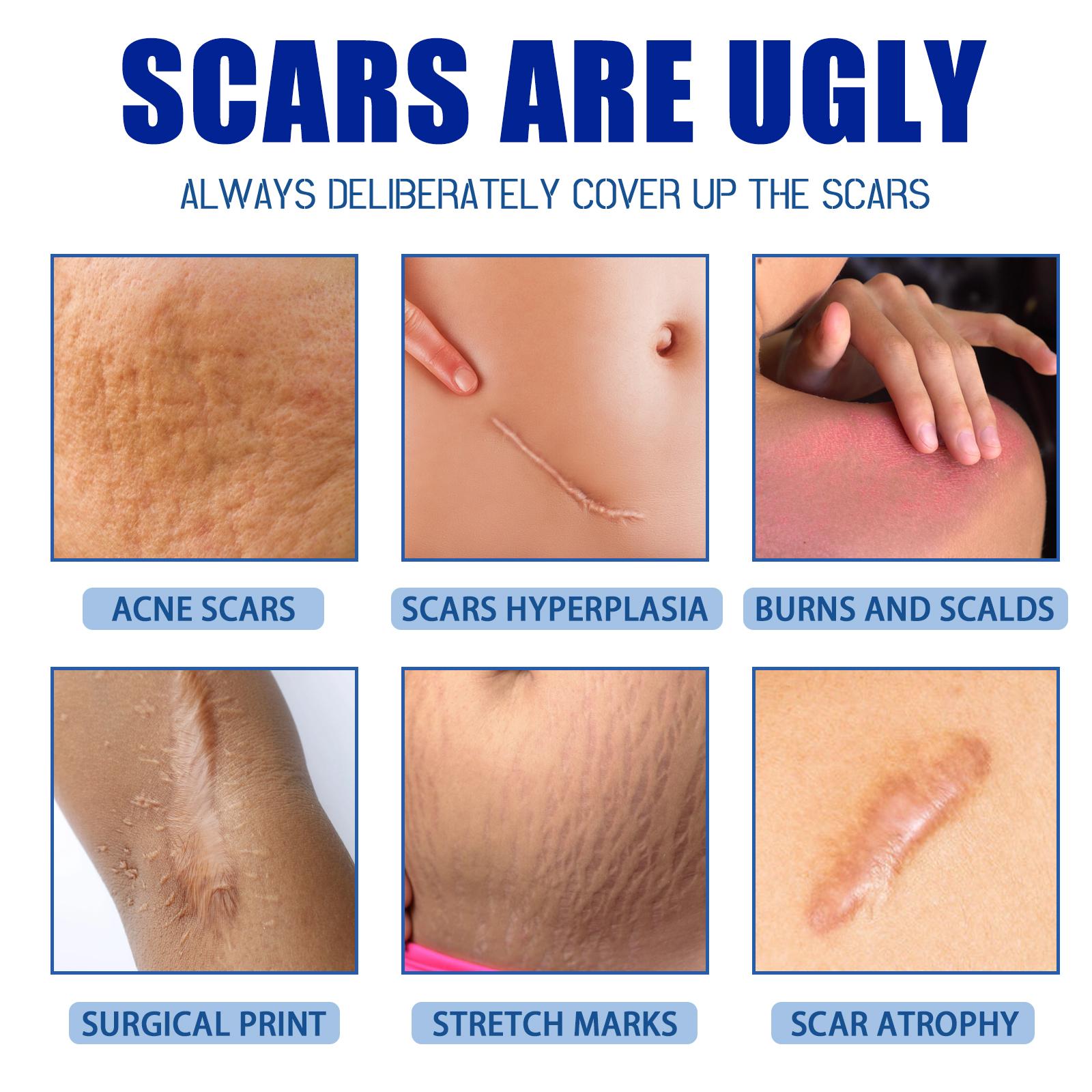 Professional Scar Removal Gel- Scarremoval treatment for keloids, C-sectionS, surgeries, burns, acne andmore.